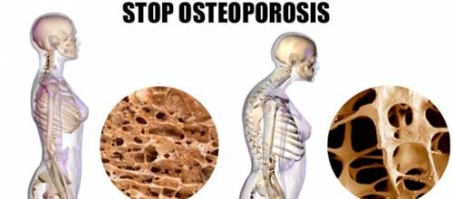 Osteoporosis: Síntomas, causas y tratamientos